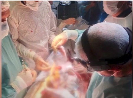 “Вперше за 15 років”: тернопільський лікар блискуче провів пересадку серця (ВІДЕО)