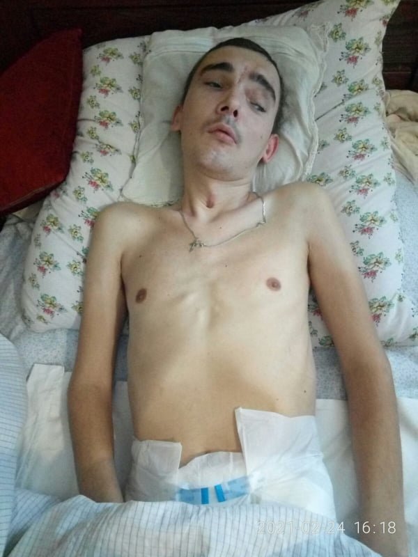“Так схуд, що мама виносила його з центру на руках”: Максим Беспалов з Тернопільщини потребує допомоги